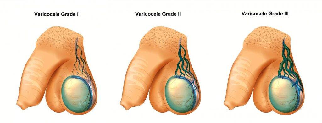 Varicocele Grading, Primary & Secondary