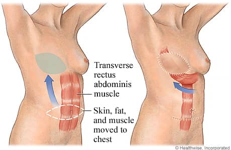 Transverse rectus abdominis muscle