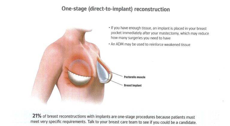one-stage (direct-to-implant) reconstruction