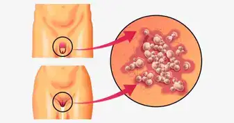 فيروس الورم الحليمي البشري hpv