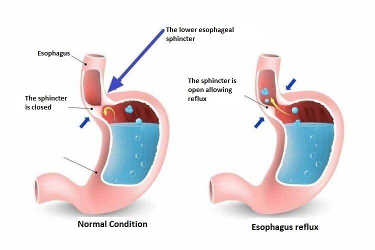 esophagus reflux