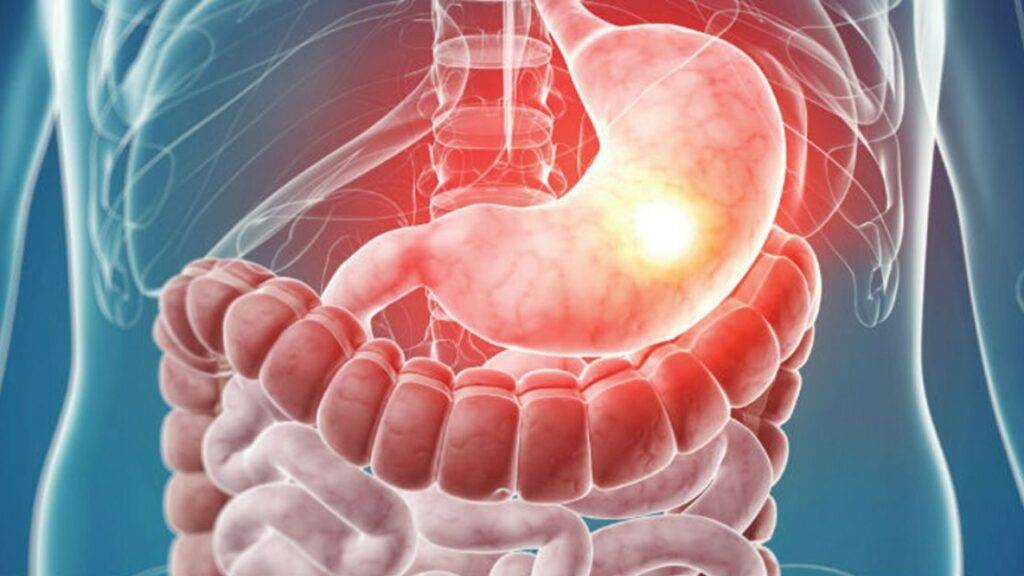 علاج التهاب المعدة في إيران نهائيا