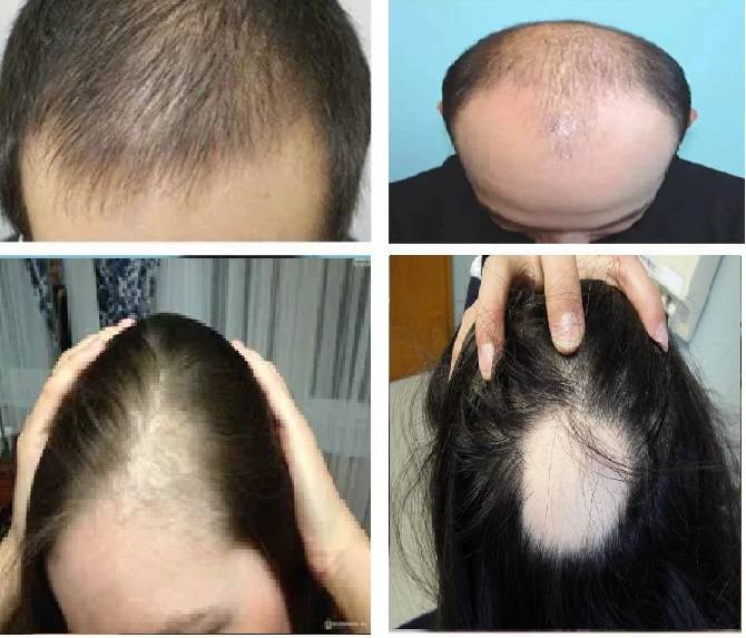 فرق زراعة الشعر بين الرجال و النساء