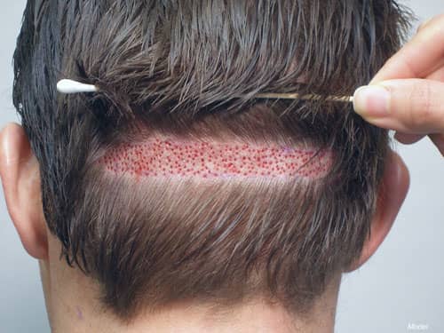 FIT زراعة الشعر في ايران بطريقة