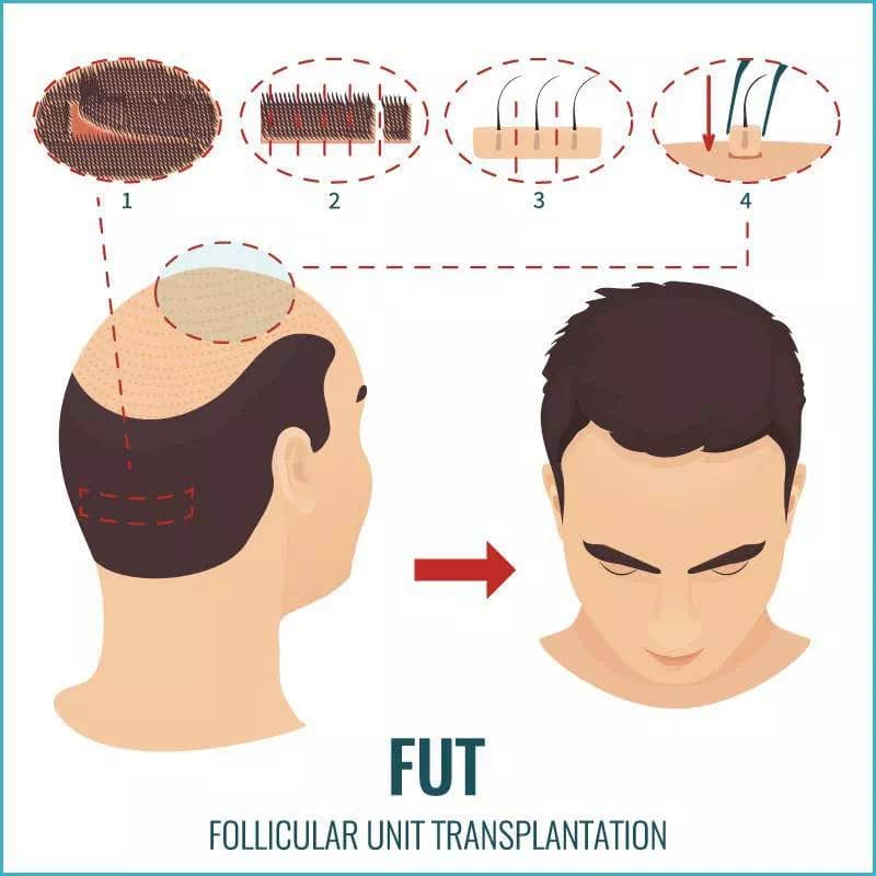 Hair Transplantation in Iran using the chip technique FUT