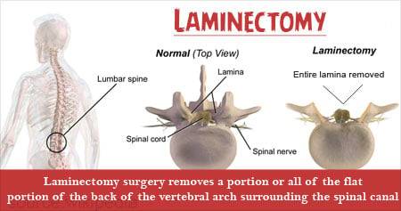 Laminectomy in Iran