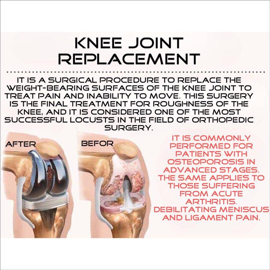 knee joint replacement in iran