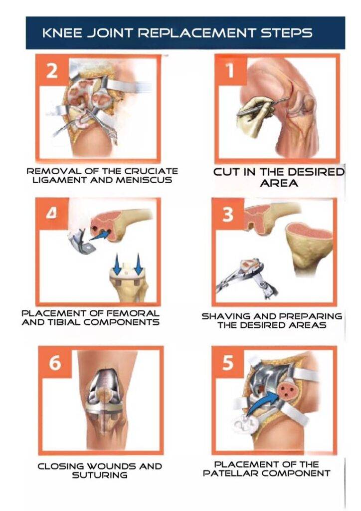 knee joint replacement steps