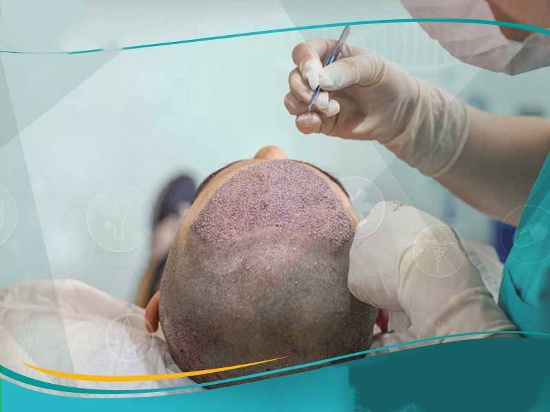أسباب تقنيات زراعة الشعر الجديدة في ايران