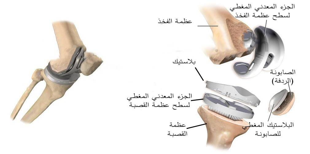 اجزاء المفاصل الصطناعية للركبة
