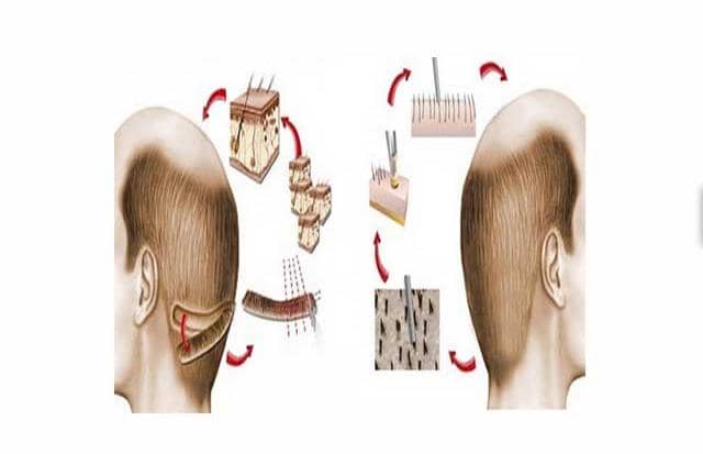 زراعة الشعر بالطرق المركبة في ايران بمدينة شيراز