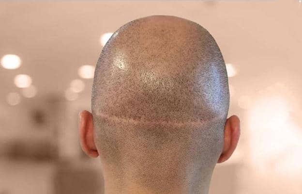 زراعة الشعر بتقنية الشريحة FUT في إيران