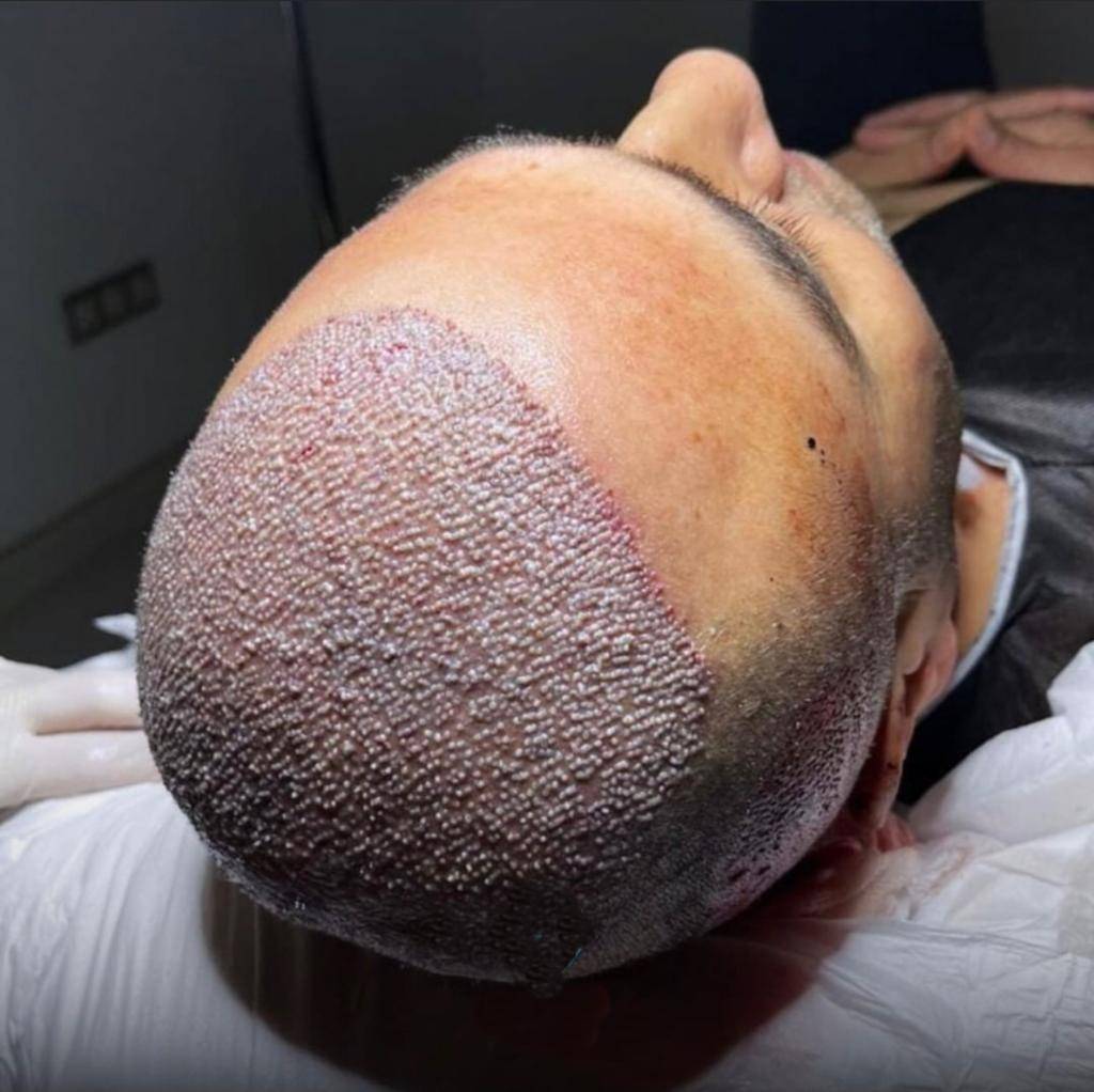 زراعة الشعر في ايران