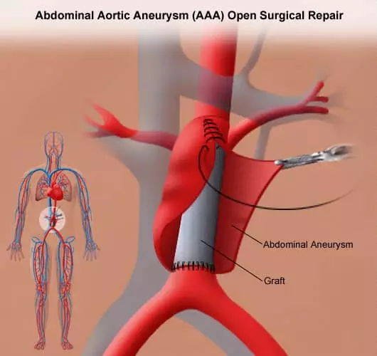 Abdominal Aortic Aneurysm (AAA) Open Surgical Repair