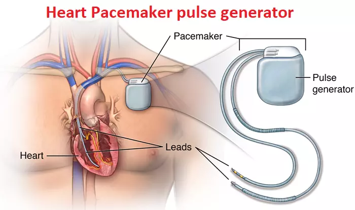 Heart pacemaker pulse generator