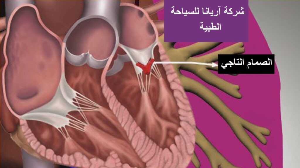 الصمام التاجي