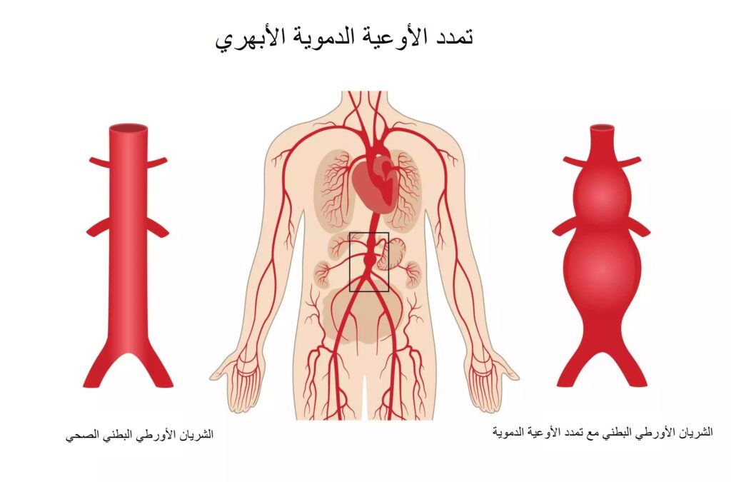 تمدد الأوعية الدموية الأبهري