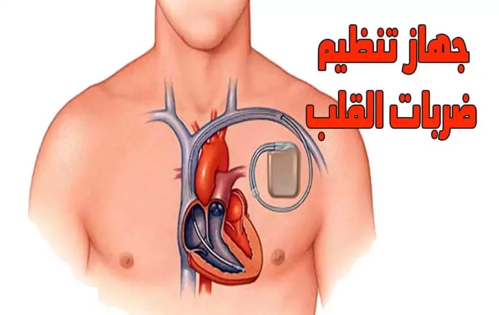 جهاز تنظيم ضربات القلب في ايران