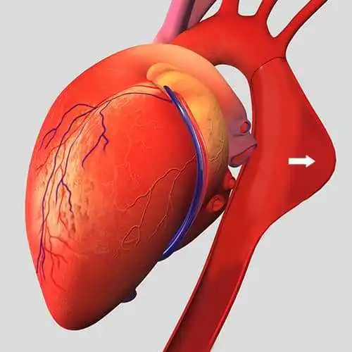 علاج تمدد الأوعية الدموية الأبهري في إيران وشيراز وطهران