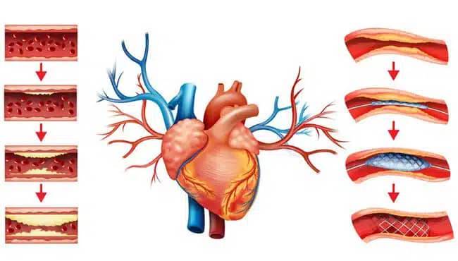 قسطرة القلب ورأب الأوعية الدموية في ايران