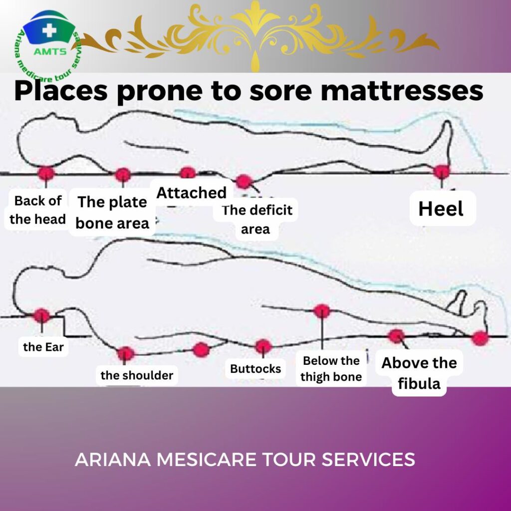 places proneto sore mattresses