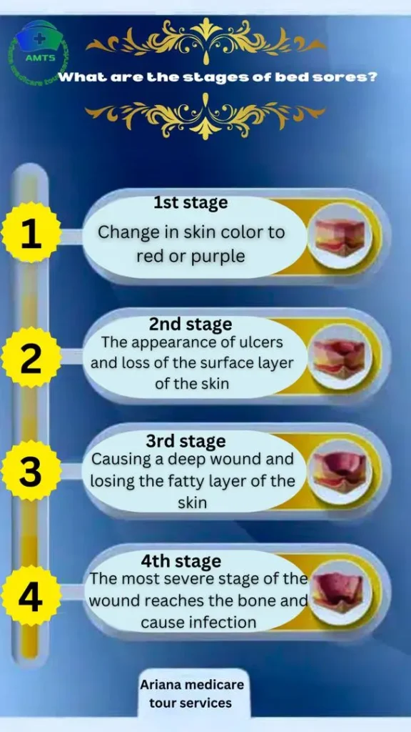 what are the stage of bed sore