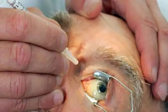 الحقن داخل العين لعلاج الشبكية في شيراز