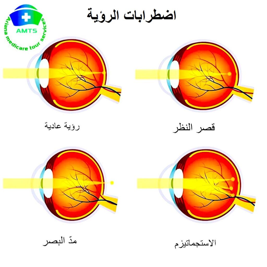 علاج الأخطاء الانكسارية للعين عند البالغین والأطفال في إيران ومدينة شيراز
